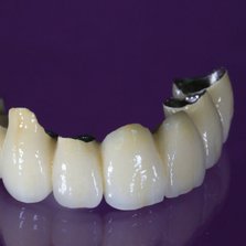 kroon brugwerk zaan dental