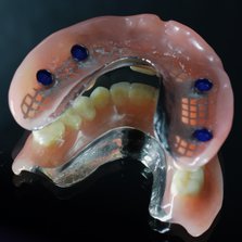 implantaat constructies zaan dental