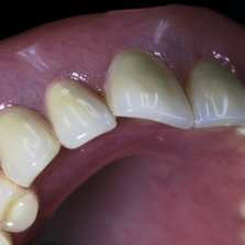 prothese kunstgebit zaan dental